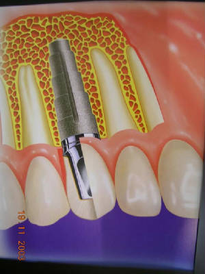 Implant dentistry